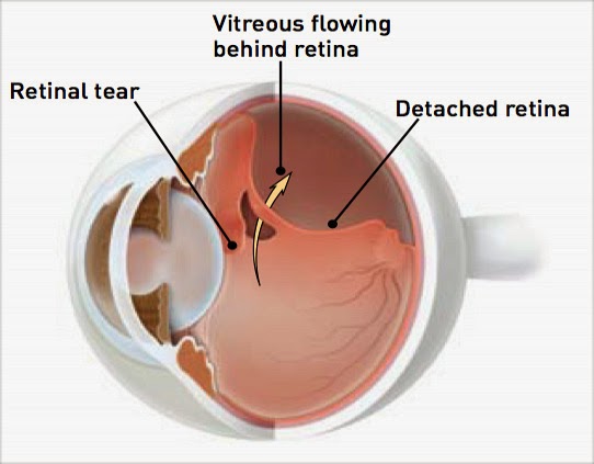 Retinal Detachment Causes And Treatment - Health And Medical 