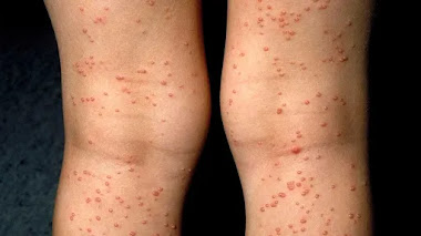 Hiv Rash síntomas en las mujeres