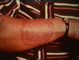 Know types of ringworm