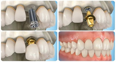 Trồng răng số 7 hết bao nhiêu tiền với răng implant 1