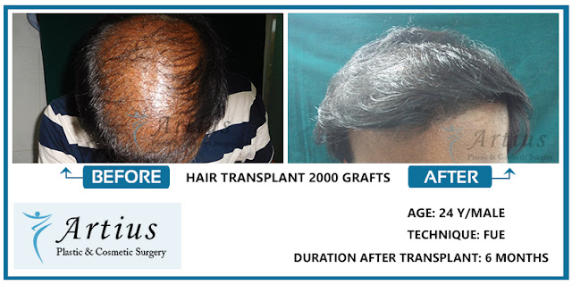 Hair Transplant in Navi Mumbai