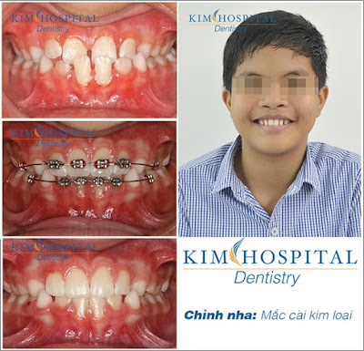 Kết quả trước và sau khi niềng răng mắc cài kim loại