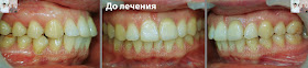 Зубы до  лечения брекетами смещенния средней линии челюсти