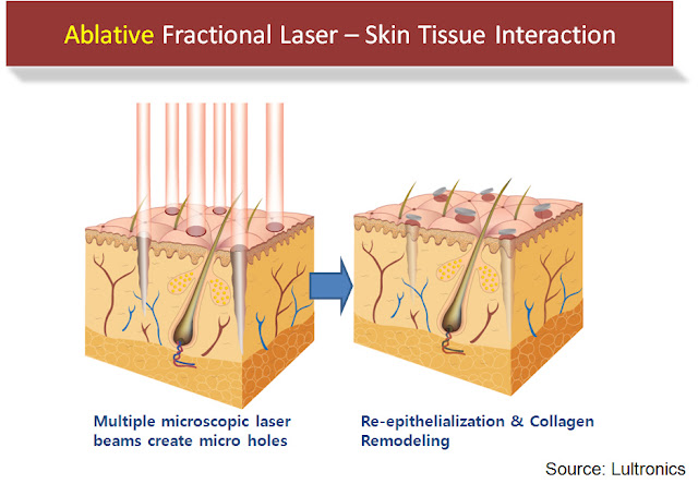 fractional co2 laser