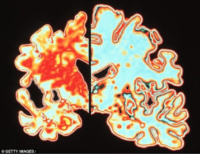 Zika could affect adult's brain like Alzheimer's