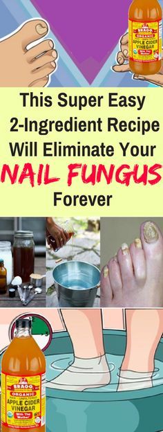 This Super Easy 2-Ingredient Recipe Will Eliminate Your Nail Fungus Forever