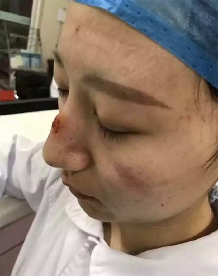Shocking Photos Depict How Chinese Nurses' Faces Look After Hours Of Treating The Coronavirus
