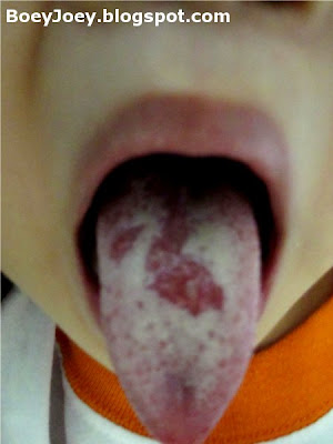 ulcers on tongue. the ulcers on her tongue