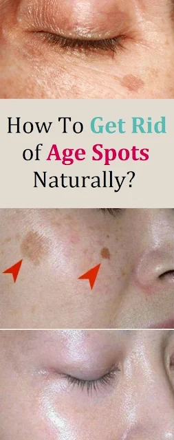 How to Get Rid of Freckles and Sun Spots