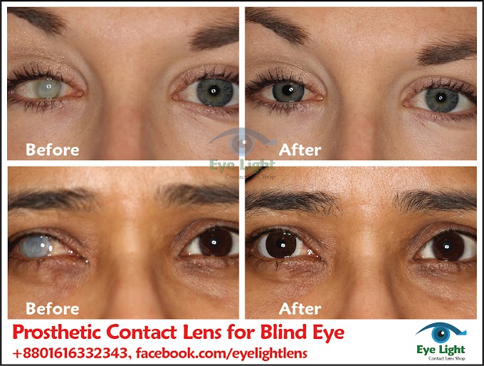 Prosthetic Contact Lens for Blind Eyes | Benefits for Damaged or Disfigured Eyes