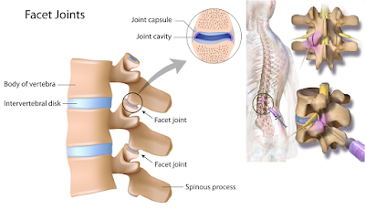 Injections for Low Back Pain in Springfield