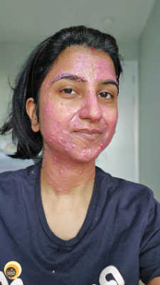 applied this natural vitamin e and c face mask on dry, combination, sensitive skin of blogger Anamika Chattopadhyaya