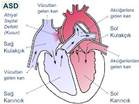 Penyebab jantung bocor dan cara mengobatinya