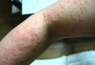 Eksim Atau Dermatitis Adalah, Mengobati Eksim Di Payudara, Obat Eksim Basah Tradisional, Cara Menyembuhkan Penyakit Eksim Di Kulit, gatal eksim Gejala, Gatal Di Selangkangan Jangan Digaruk, Mengobati gatal eksim Dengan Herbal, Salep Eksim Kering Mujarab, gatal eksim Ciri, Gambar Eksim Pada Bayi, Tips Mengatasi gatal eksim, gatal eksim Tak Kunjung Sembuh, Eksim Pada Anak, gatal eksim Di Kemaluan, Penyakit Eksim Kaki, gatal akibat eksim, Apa Nama Obat gatal eksim Kering, Obat gatal eksim Pada Kulit Bayi, Obat Generik Untuk Eksim Basah, Www.Obat gatal eksim Basah, Eksim Basah Di Kaki, Cara Pengobatan gatal eksim Secara Tradisional, Penyakit gatal eksim Kaskus, Obat Eksim Untuk Balita, Gatal Di Selangkangan Sampai Bokong, Gatal Di Kemaluan Bagian Dalam, Obat gatal eksim Pada Payudara, Pengobatan Penyakit Kulit gatal eksim, Gatal Selangkangan Obat, Cara Mengatasi Eksim Basah Secara Alami, Gatal Jamur Di Kemaluan Pria, Eksim Buah Zakar, Penyakit Kulit gatal eksim Menular Tidak, Bumbu Dapur Obat gatal eksim Kering, Obat gatal eksim Terbaik  