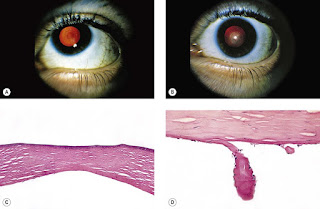 keratoconus journal