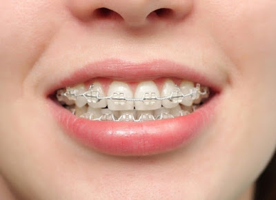 Các bước tiến hành niềng răng hô hàm trên-2