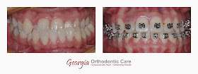 Underbite, Class III treatment, non-surgery treatment, Lawrenceville orthodontist, Norcross orthodontist, Gwinnett orthodontist, orthodontists, orthodontics, under bite, over bite, Georgia Orthodontic Care, Dr Nguyen, Cosmetic, Implant, Children, Family, Dentists, Clear, Braces, Invisible, Adults, Teens, Children, Clear Braces, Invisible Braces, Invisalign, Straighten, Teeth, Lawrenceville, Norcross, Buford, Hamilton Mill, Dacula, Auburn, Sugar Hill, Sugar Loaf, Doraville, Chamblee, Stone Mountain, Decatur, Collins Hill, Snellville, Suwanee, Grayson, Lilburn, Duluth, Cumming, Alpharetta, Marietta, Dekalb County, Gwinnett County, Atlanta, North Georgia, GA, Georgia, 30043, 30093