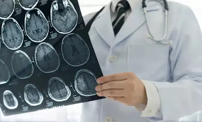 5 Gejala Stroke yang Harus Diwaspadai dan Cara Mencegahnya
