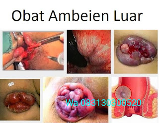 obat pengempes ambeien luar paling manjur