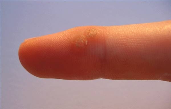 common warts on face. Common warts are local growths in the skin that are caused by human papillomavirus (HPV) infection. Although they are considered to be contagious,