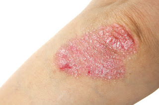 Como Se Cura La Psoriasis