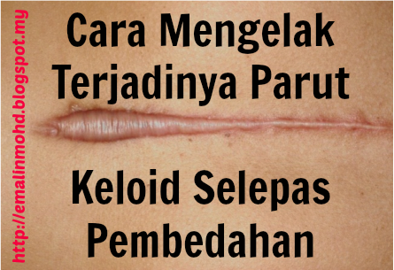 Cara Mengelak Terjadinya Parut Keloid Selepas Pembedahan 