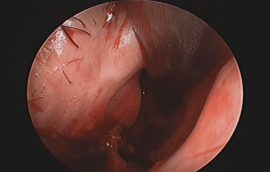 Rhinoscopy-in-chronic-hypertrophic-rhinitis