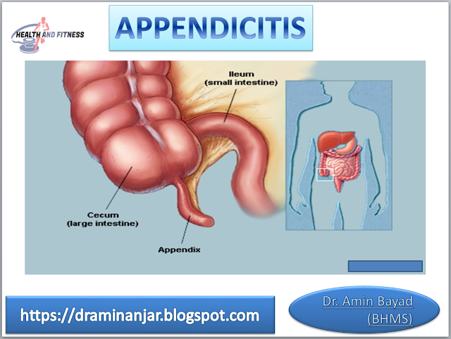 location of appendicitis