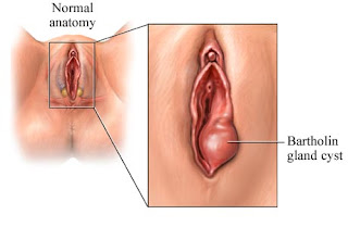 Bartholinitis Bartolinitis