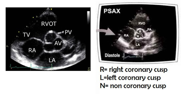 Magnified view of Parasternal Short Axis View (PSAX) at the level of Aortic Valve (AV) showing three cusps of AV