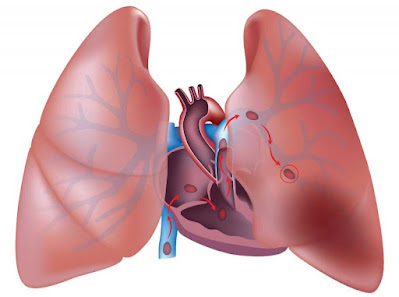 Pulmonary Arterial Hypertension Market