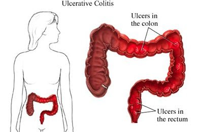 ulcerative colitis symptoms