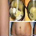 How Remove Erase Stretch Marks Only 1 Week