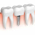 Trồng răng implant có đau lắm hay không ?
