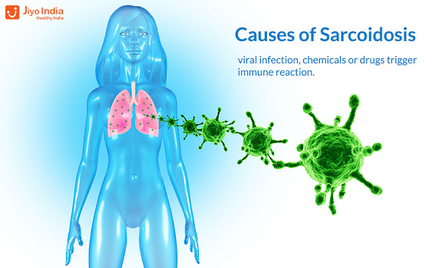 Causes of Sarcoidosis 