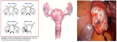 endometriosis6