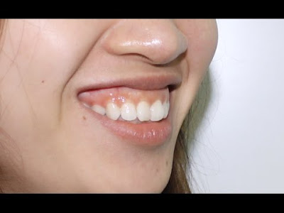 Một vài thông tin về răng hô bạn cần biết