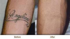 Before and after pictures of tattoo removal