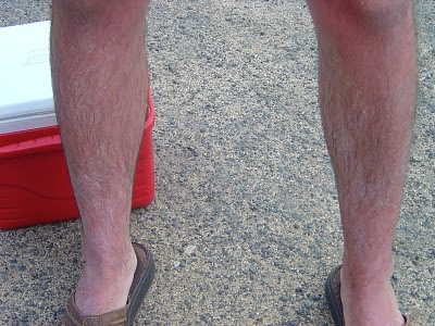 Sunburned legs in Waikiki, Hawaii