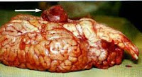 tumeur du cerveau,cancer du cerveau symptomes,cancer du cerveau traitement.Le cancer du cerveau est une maladie du cerveau où les cellules cancéreuses (malignes ) se développent dans le tissu cérébral.