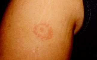 Lymes Disease Pictures