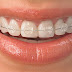 Niềng răng Invisalign là gì?