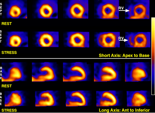 Nuclear Cardiology Case