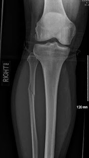 original broke leg x-ray