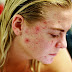 Thirteen ways to remove acne scars quickly in one day