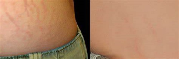 How to Remove Stretch Marks Without Surgery