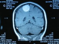 MRI with Meningioma