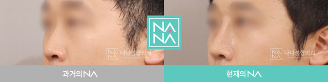 rhinoplasty, korean plastic surgery, plastic surgery in korea, before and after, before and after nose surgery, nana plastic surgery, nana hospital, nose job, nose job in korea, korean nose job, korean rhinoplasty, rhinoplasty in korea, rhinoplasty surgeon,