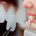 Bọc răng sứ Cercon giá bao nhiêu là hợp lý?