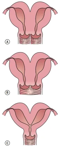 Types of uterine malformation